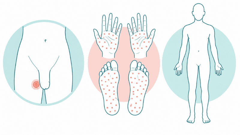 Medical illustration showing what syphilis looks like at the primary chancre stage, secondary rash stage, and latent stage
